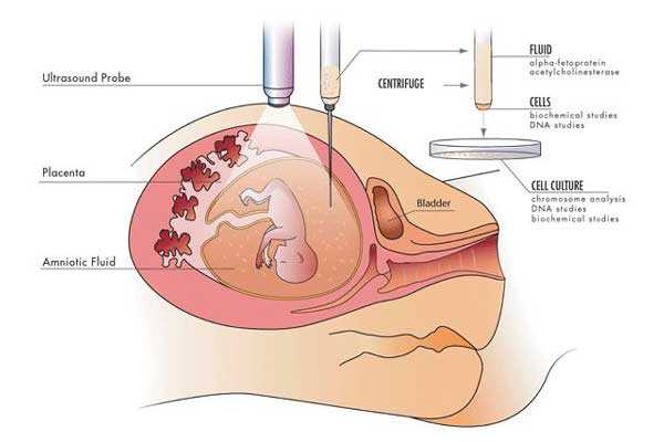 香港验血胎儿性别费用多少,宫腔积液如何影响辅助生殖技术中助孕过程？